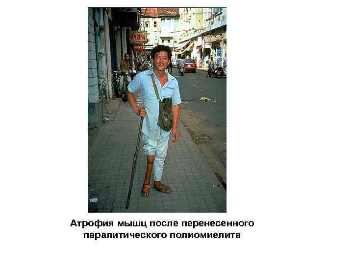 Атрофия мышц после перенесенного паралитического полиомиелита 