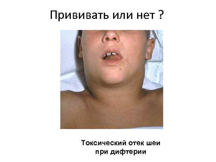 Прививать или нет ? Токсический отек шеи при дифтерии 