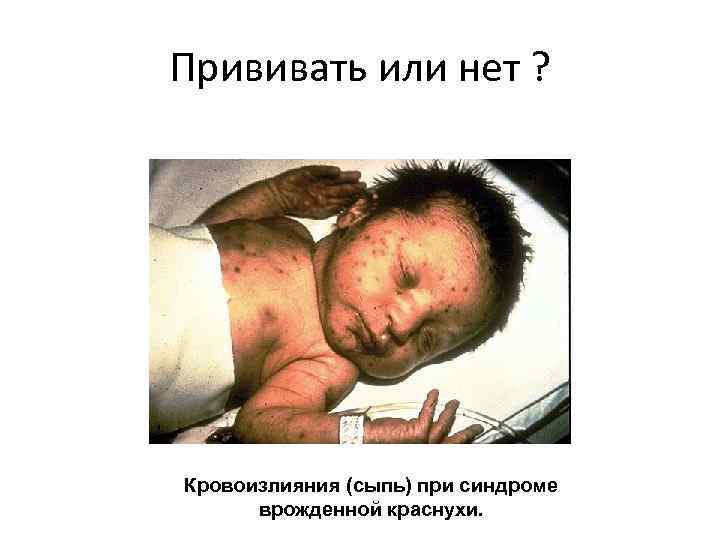 Прививать или нет ? Кровоизлияния (сыпь) при синдроме врожденной краснухи. 