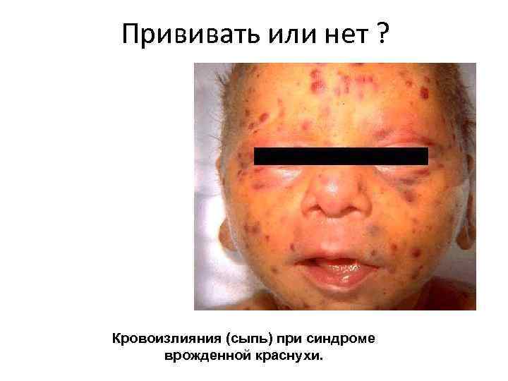 Прививать или нет ? Кровоизлияния (сыпь) при синдроме врожденной краснухи. 