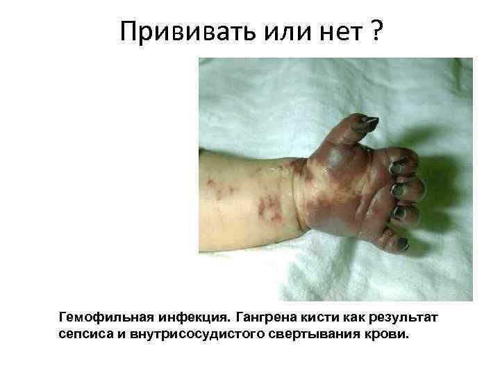 Прививать или нет ? Гемофильная инфекция. Гангрена кисти как результат сепсиса и внутрисосудистого свертывания