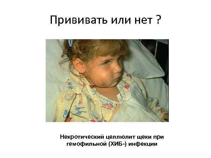 Прививать или нет ? Некротический целлюлит щеки при гемофильной (ХИБ-) инфекции 