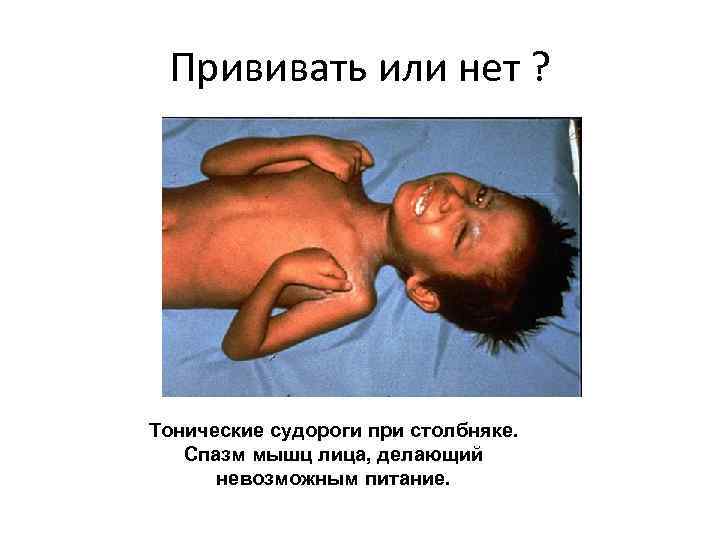 Прививать или нет ? Тонические судороги при столбняке. Спазм мышц лица, делающий невозможным питание.