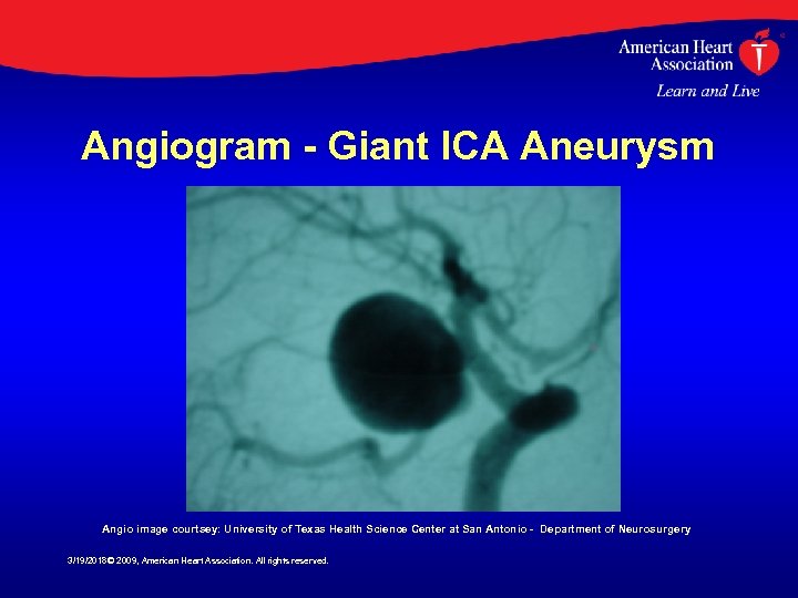 Angiogram - Giant ICA Aneurysm Angio image courtsey: University of Texas Health Science Center