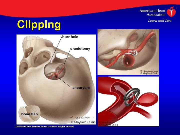 Clipping 3/19/2018© 2009, American Heart Association. All rights reserved. 