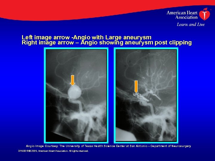 Left image arrow -Angio with Large aneurysm Right image arrow – Angio showing aneurysm