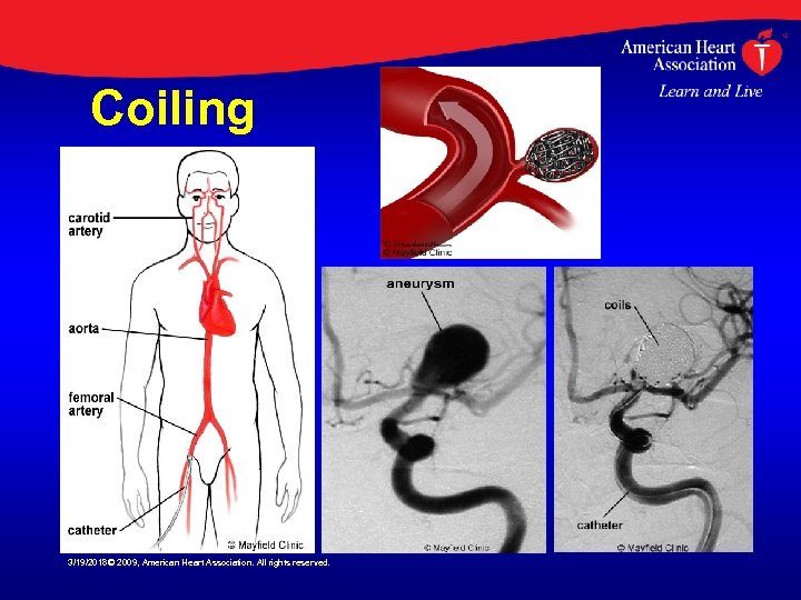 Coiling 3/19/2018© 2009, American Heart Association. All rights reserved. 