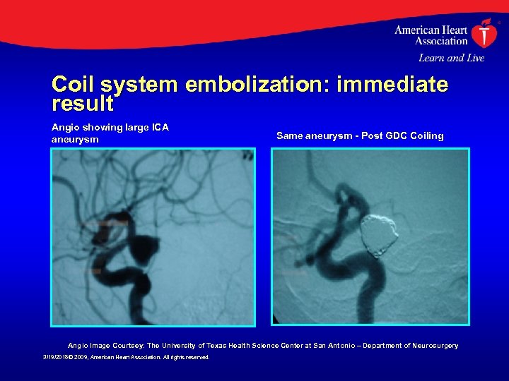 Coil system embolization: immediate result Angio showing large ICA aneurysm Same aneurysm - Post