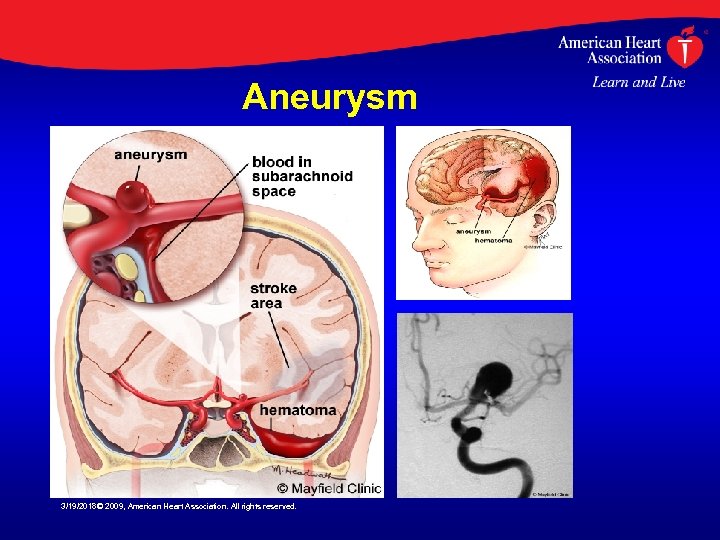 Aneurysm 3/19/2018© 2009, American Heart Association. All rights reserved. 