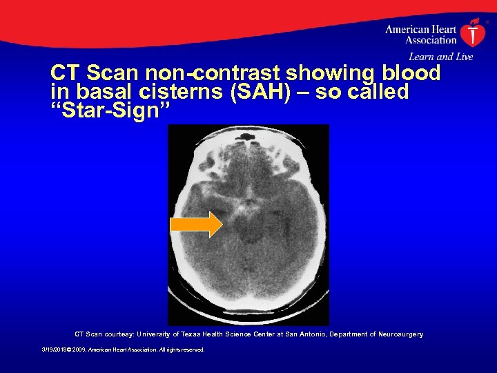 CT Scan non-contrast showing blood in basal cisterns (SAH) – so called “Star-Sign” CT