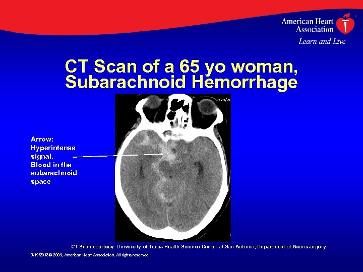 CT Scan of a 65 yo woman, Subarachnoid Hemorrhage Arrow: Hyperintense signal. Blood in