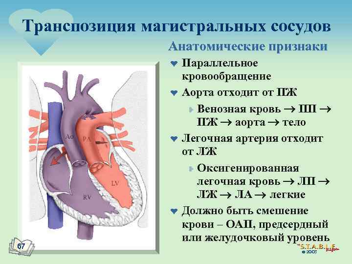 Транспозиция магистральных сосудов Анатомические признаки ¤ ¤ 67 Параллельное кровообращение Аорта отходит от ПЖ