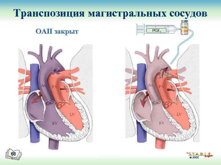 Транспозиция магистральных сосудов ОАП закрыт 68 PGE 1 © 2003 