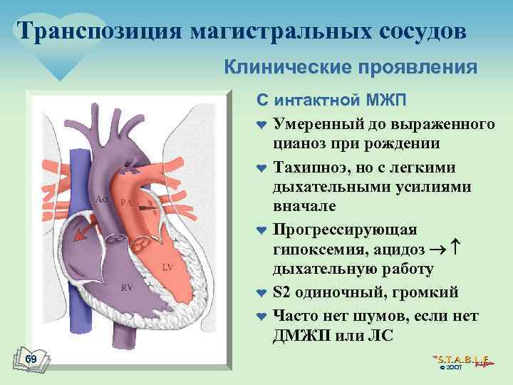 Транспозиция магистральных сосудов Клинические проявления С интактной МЖП ¤ Умеренный до выраженного цианоз при