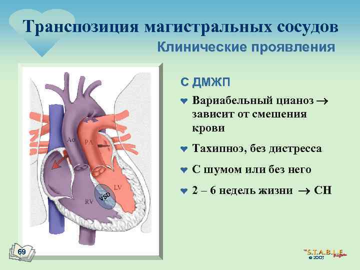 Транспозиция магистральных сосудов Клинические проявления С ДМЖП ¤ Вариабельный цианоз зависит от смешения крови