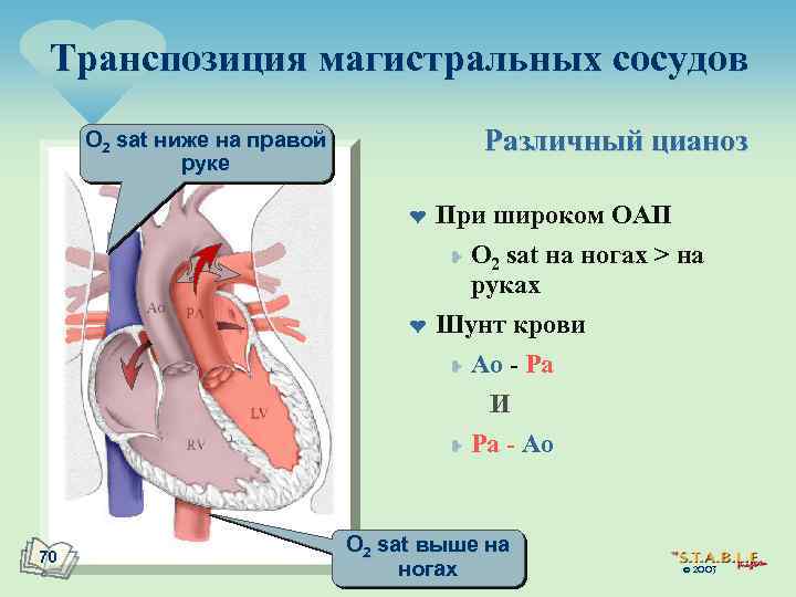 Транспозиция магистральных сосудов Различный цианоз O 2 sat ниже на правой руке ¤ ¤