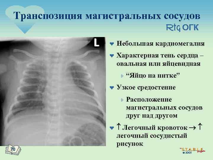 Транспозиция магистральных артерий презентация