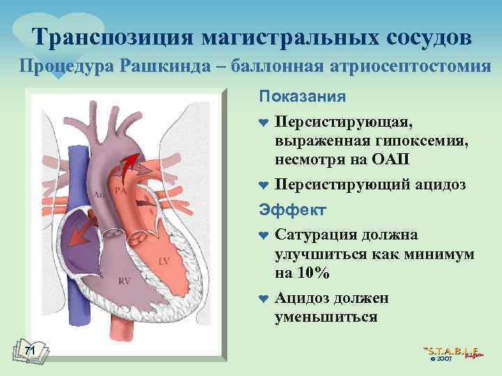 Транспозиция магистральных сосудов Процедура Рашкинда – баллонная атриосептостомия Показания ¤ Персистирующая, выраженная гипоксемия, несмотря