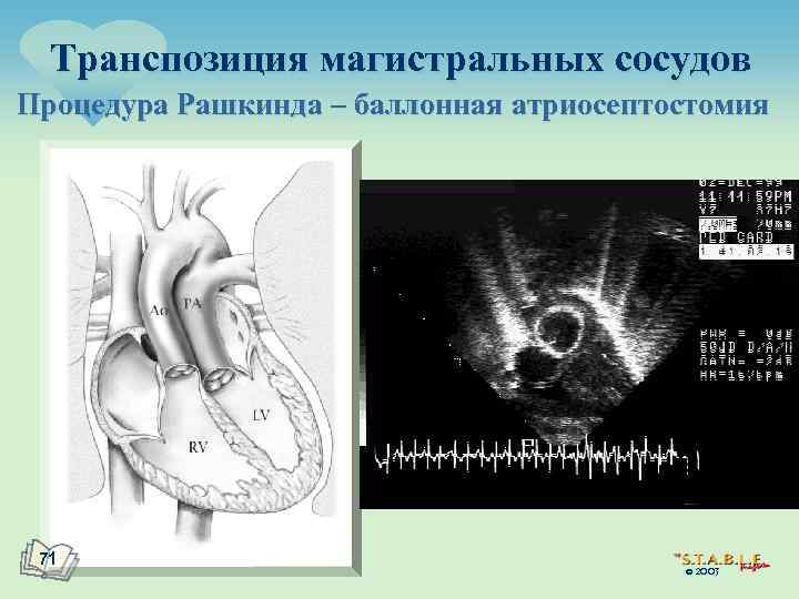 Транспозиция магистральных сосудов Процедура Рашкинда – баллонная атриосептостомия 71 © 2003 