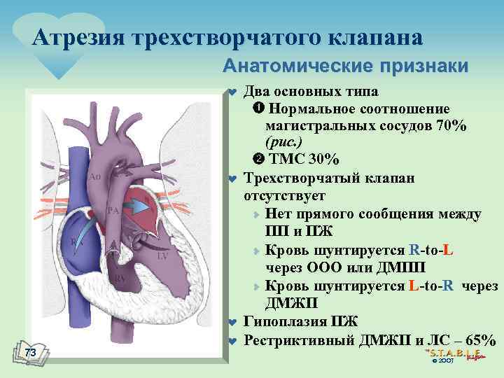 Атрезия трехстворчатого клапана Анатомические признаки ¤ ¤ ¤ 73 ¤ Два основных типа Нормальное