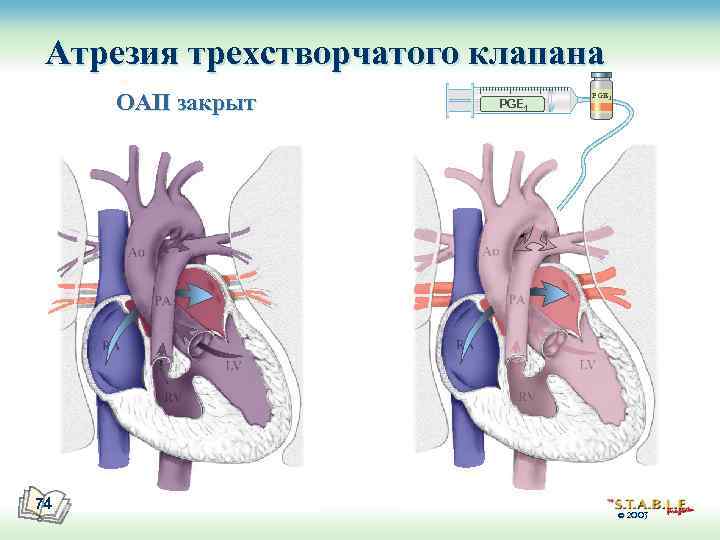 Атрезия трехстворчатого клапана ОАП закрыт 74 PGE 1 © 2003 