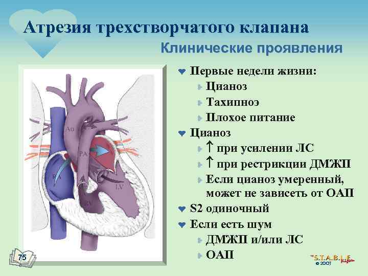 Атрезия трехстворчатого клапана Клинические проявления ¤ ¤ 75 Первые недели жизни: ¥ Цианоз ¥