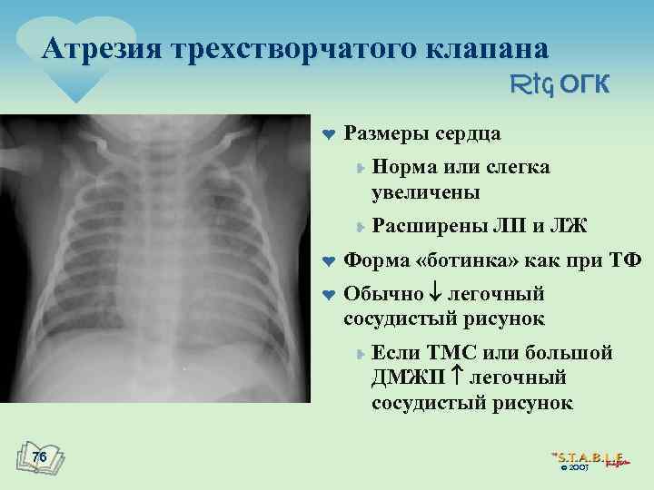 Атрезия трехстворчатого клапана Rtg ОГК ¤ Размеры сердца ¥ ¥ ¤ ¤ Расширены ЛП