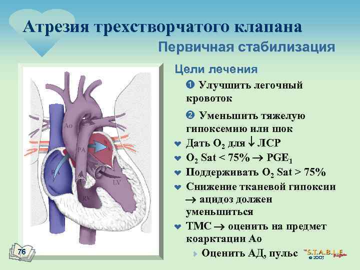 Атрезия трехстворчатого клапана презентация