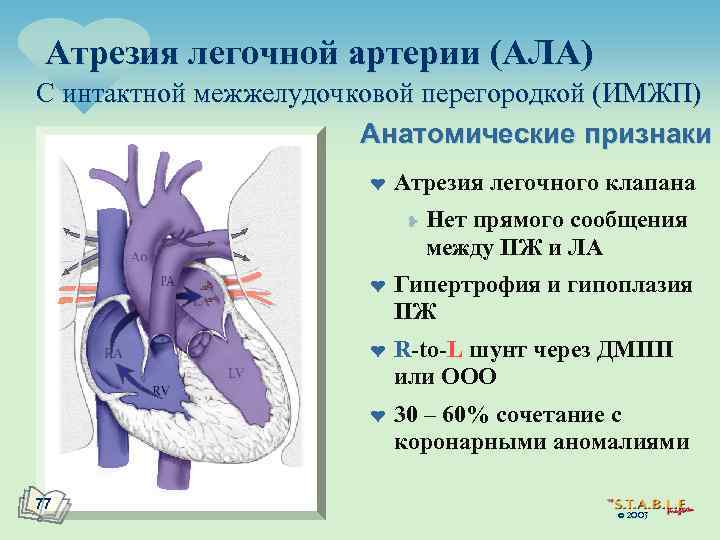 Атрезия легочной артерии (АЛА) С интактной межжелудочковой перегородкой (ИМЖП) Анатомические признаки ¤ Атрезия легочного