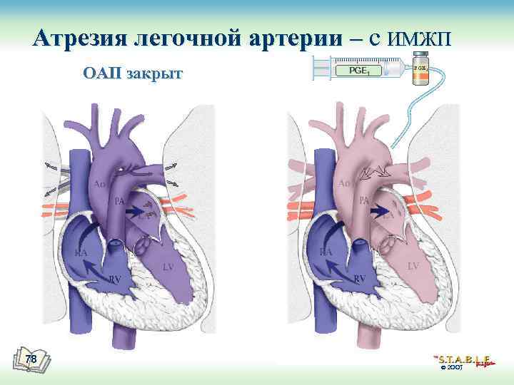 Атрезия легочной артерии – с ИМЖП ОАП закрыт 78 PGE 1 © 2003 