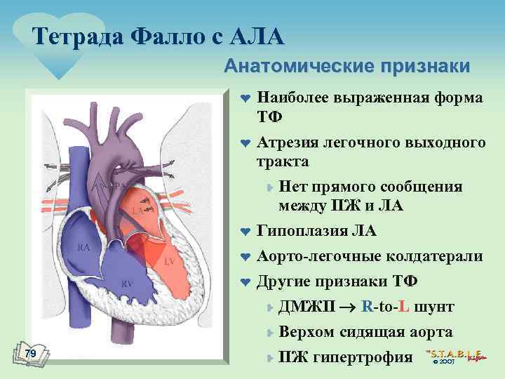 Тетрада Фалло с АЛА Анатомические признаки ¤ ¤ ¤ 79 Наиболее выраженная форма ТФ