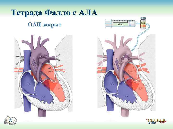 Тетрада Фалло с АЛА ОАП закрыт 80 PGE 1 © 2003 