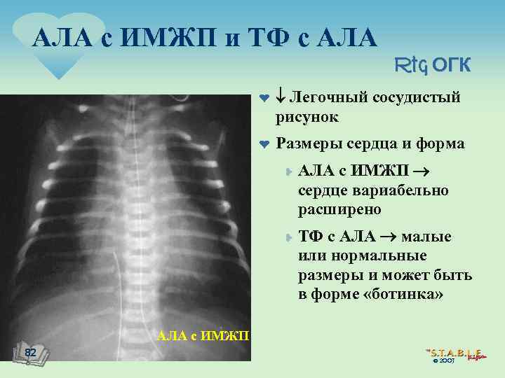 АЛА с ИМЖП и ТФ с АЛА Rtg ОГК ¤ ¤ Легочный сосудистый рисунок