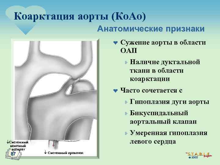 Коарктация аорты (Ко. Ао) Анатомические признаки ¤ Сужение аорты в области ОАП ¥ ¤