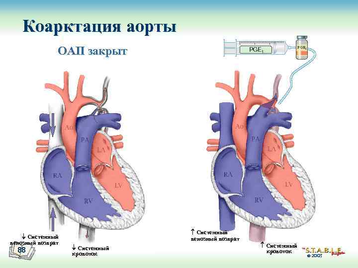 Коарктация аорты ОАП закрыт Системный венозный возврат 88 PGE 1 Системный венозный возврат Системный