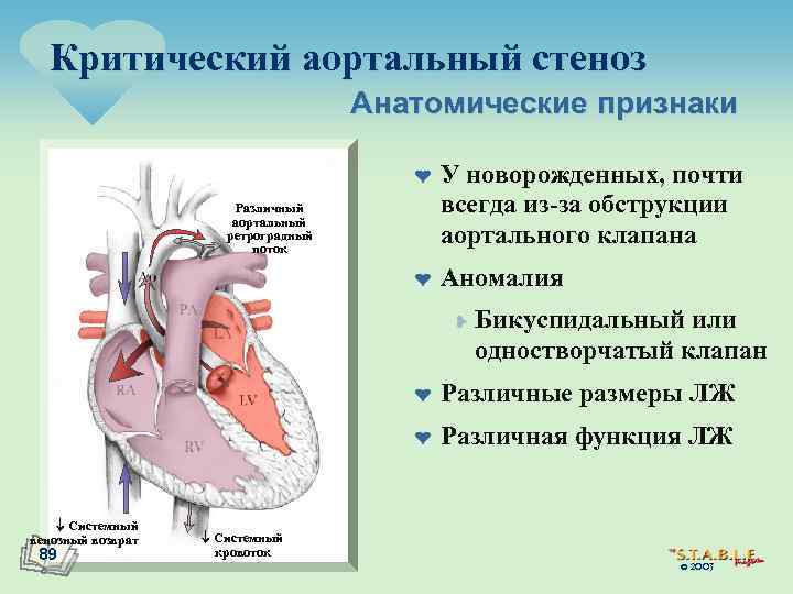 Критический аортальный стеноз Анатомические признаки ¤ Различный аортальный ретроградный поток ¤ У новорожденных, почти