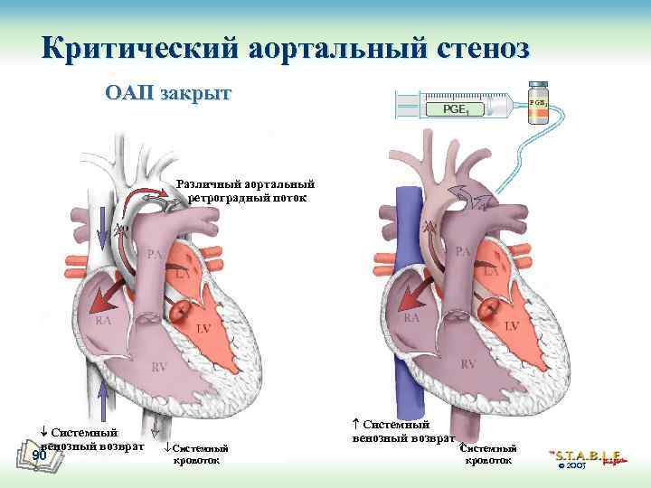 Критический аортальный стеноз ОАП закрыт PGE 1 Различный аортальный ретроградный поток Системный венозный возврат