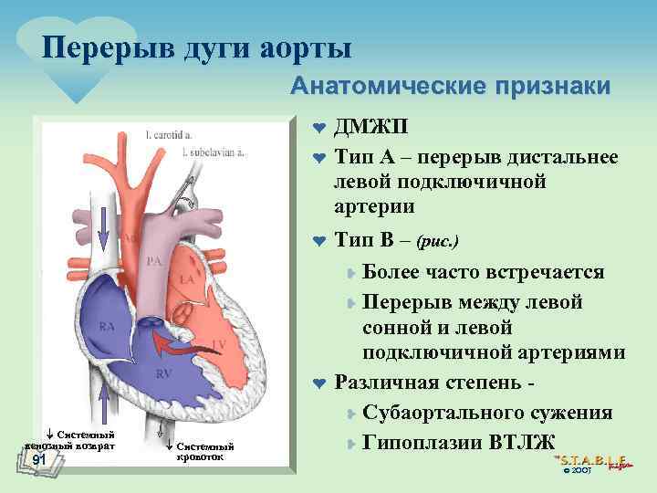 Перерыв дуги аорты Анатомические признаки ¤ ¤ Системный венозный возврат 91 Системный кровоток ДМЖП