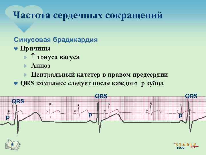 Частота сердечных сокращений Синусовая брадикардия ¤ Причины ¥ тонуса вагуса ¥ Апноэ ¥ Центральный