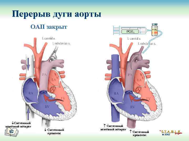 Перерыв дуги аорты ОАП закрыт Системный венозный возврат 92 Системный кровоток PGE 1 Системный