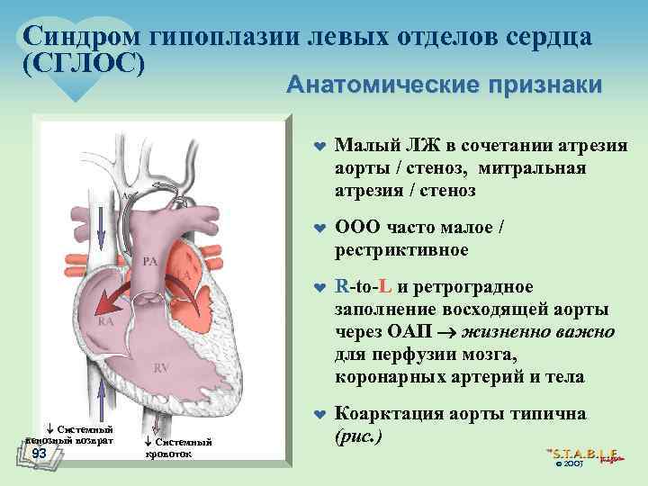 Синдром гипоплазии левых отделов сердца (СГЛОС) Анатомические признаки ¤ ¤ Системный венозный возврат 93