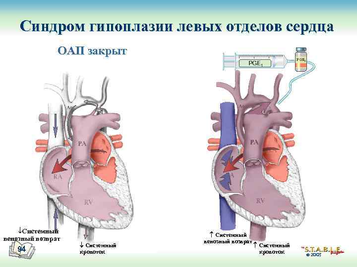 Синдром гипоплазии левых отделов сердца ОАП закрыт PGE 1 ¯Системный венозный возврат 94 Системный