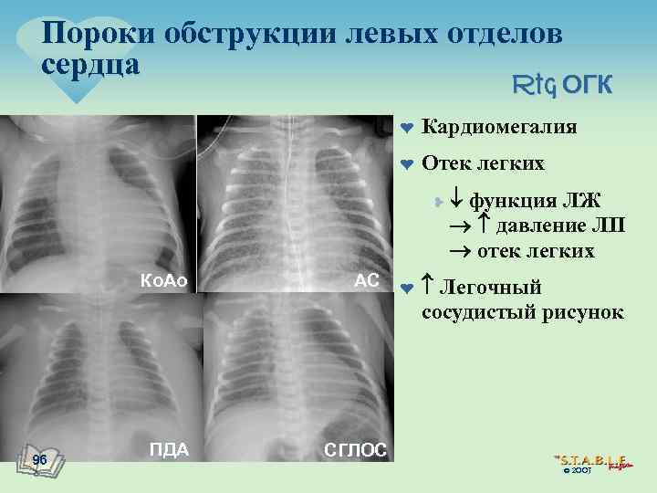 Пороки обструкции левых отделов сердца Rtg ОГК L ¤ Кардиомегалия ¤ Отек легких ¥