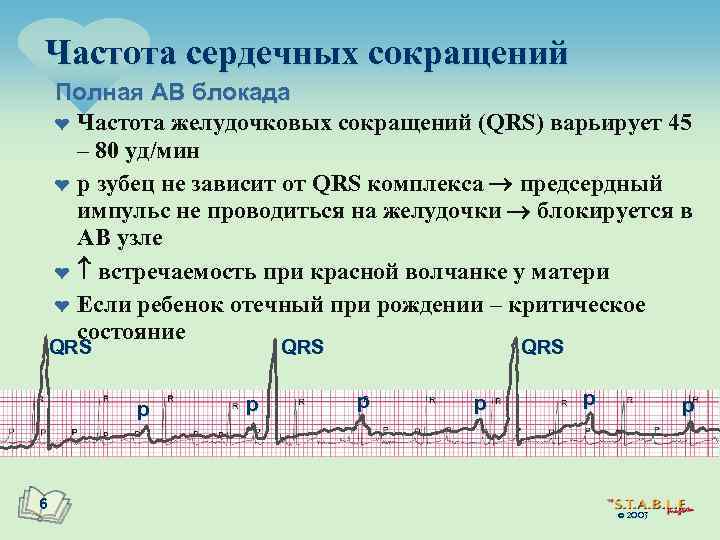 Частота сердечных сокращений Полная АВ блокада ¤ Частота желудочковых сокращений (QRS) варьирует 45 –