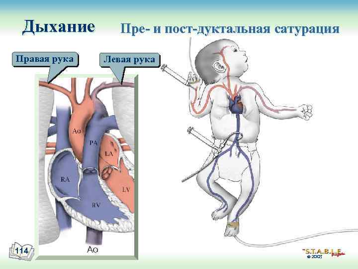 Дыхание Правая рука 114 Пре- и пост-дуктальная сатурация Левая рука Ao © 2003 