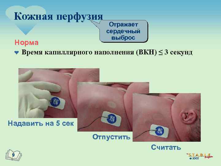 Кожная перфузия Отражает сердечный выброс Норма ¤ Время капиллярного наполнения (ВКН) ≤ 3 секунд