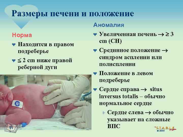 Размеры печени и положение Норма ¤ Находится в правом подреберье ¤ 2 cm ниже