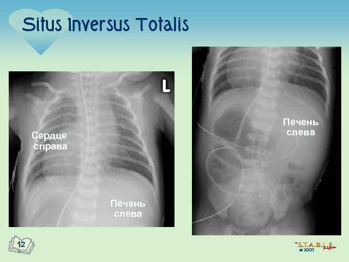 Situs Inversus Totalis Печень слева Сердце справа Печень слева 12 © 2003 