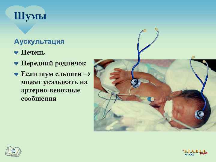 Шумы Аускультация ¤ Печень ¤ Передний родничок ¤ Если шум слышен может указывать на