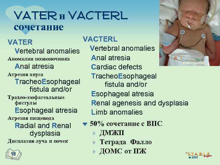 VATER и VACTERL сочетание VACTERL VATER Vertebral anomalies Anal atresia Аномалии позвоночника Anal atresia